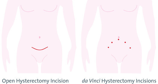 Hysterectomy_incision_compa.jpg
