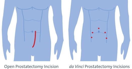 prostate_incision_compariso.jpg